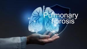 The significant differences the investigators uncovered between real-world nintedanib usage and clinical trials suggest that more studies are warranted. | Image credit: mi_viri - stock.adobe.com