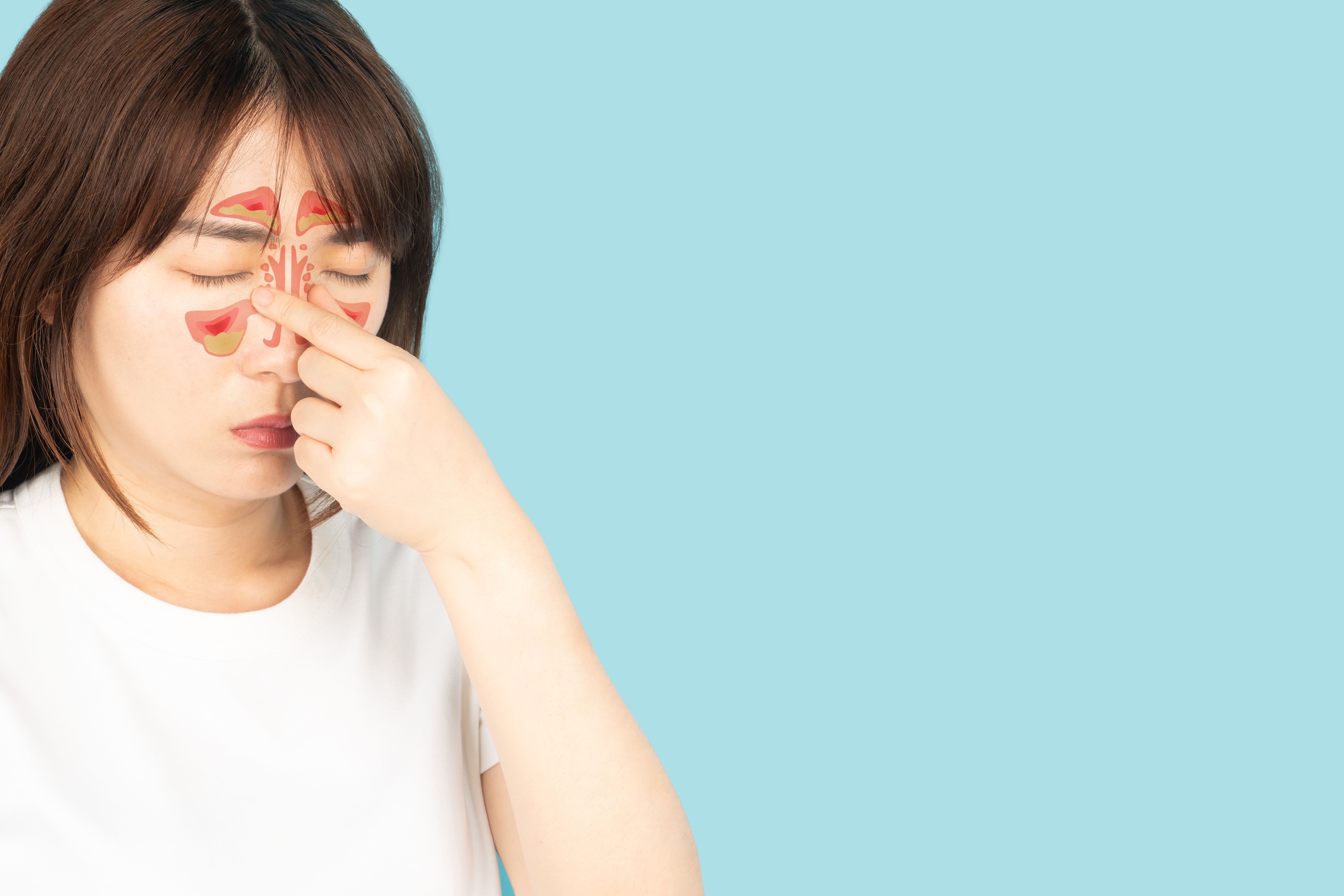Chronic rhinosinusitis with nasal polyps | Image Credit: Orawan -  stock.adobe.com