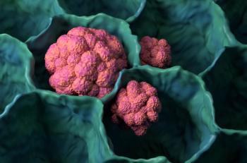 Magnified lung cancer | Image credit: Laszlo - stock.adobe.com