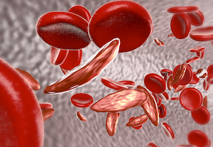 Pediatric Sickle Cell Disease Drug Gains European Orphan Designation