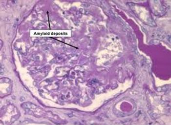 Amyloidosis is a rare condition with no approved treatments beyond the initial diagnosis stage. | Image: Stanford Medicine  