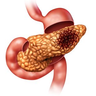 Topline Results for Olaparib Maintenance Show Improved PFS in BRCA-Mutated Pancreatic Cancer