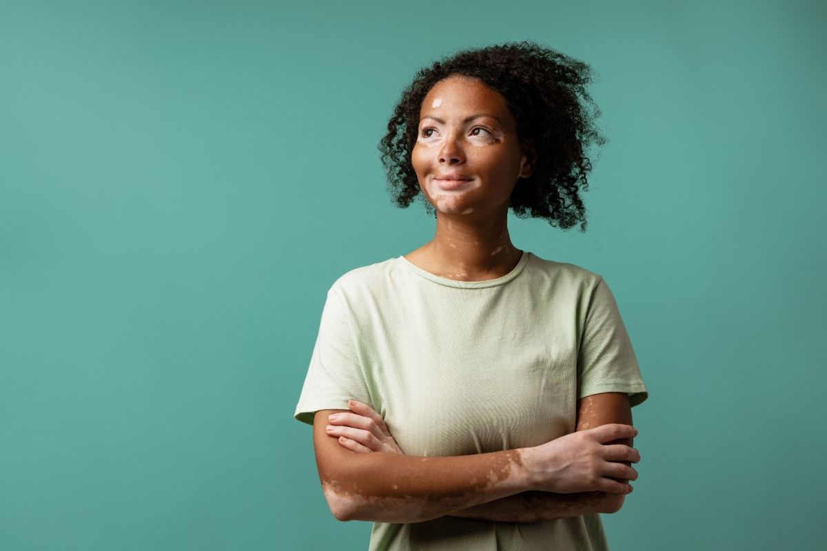 Young woman with vitiligo smiling while posing with arms crossed | Image Credit: © Drobot Dean - stock.adobe.com.