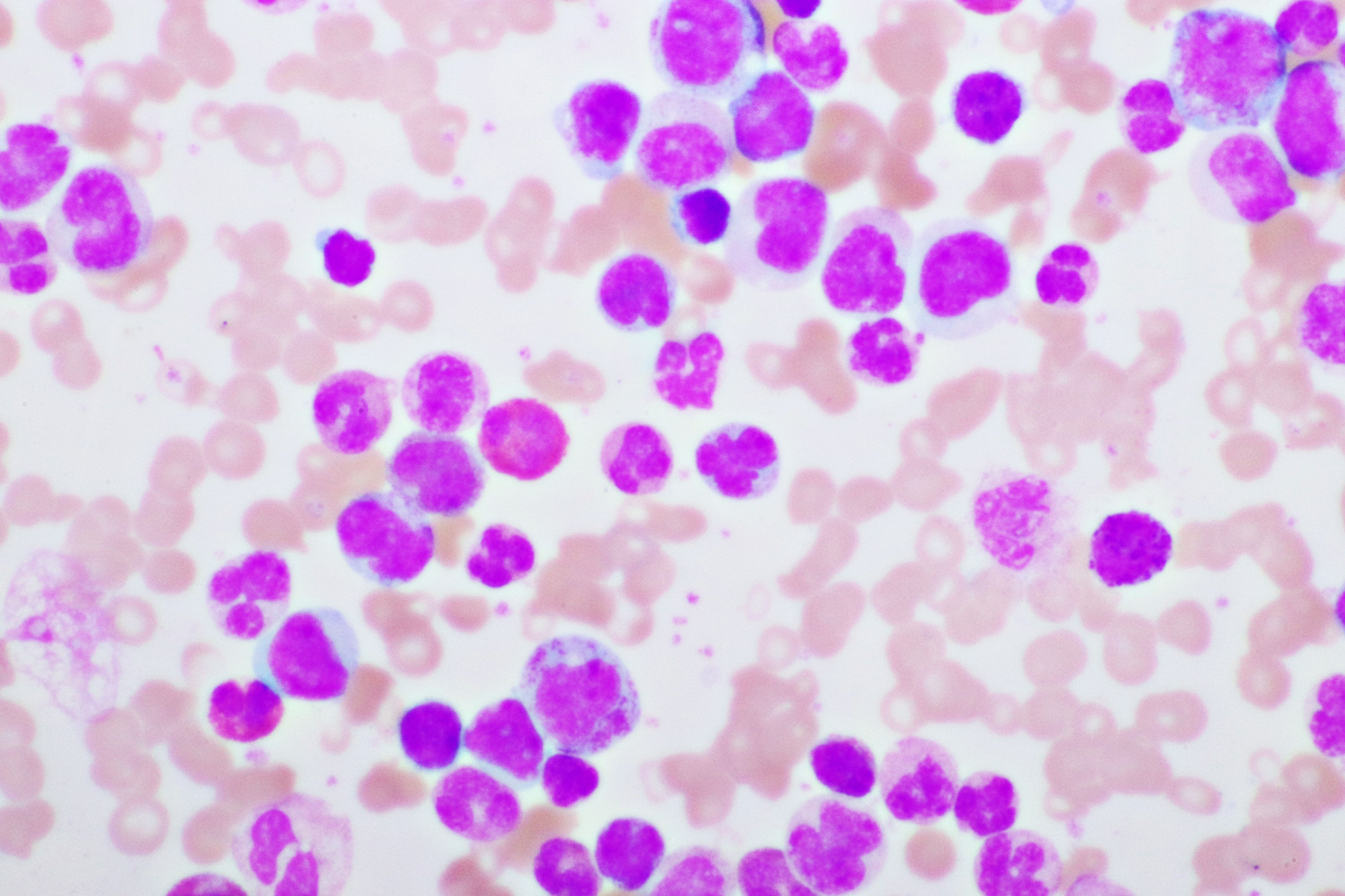 CLL cells magnified/stained | image credit: jarun011 - stock.adobe.com 