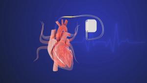 implantable cardioverter | Image Credit: © defibrillator-Silver Place-stock.adobe.com