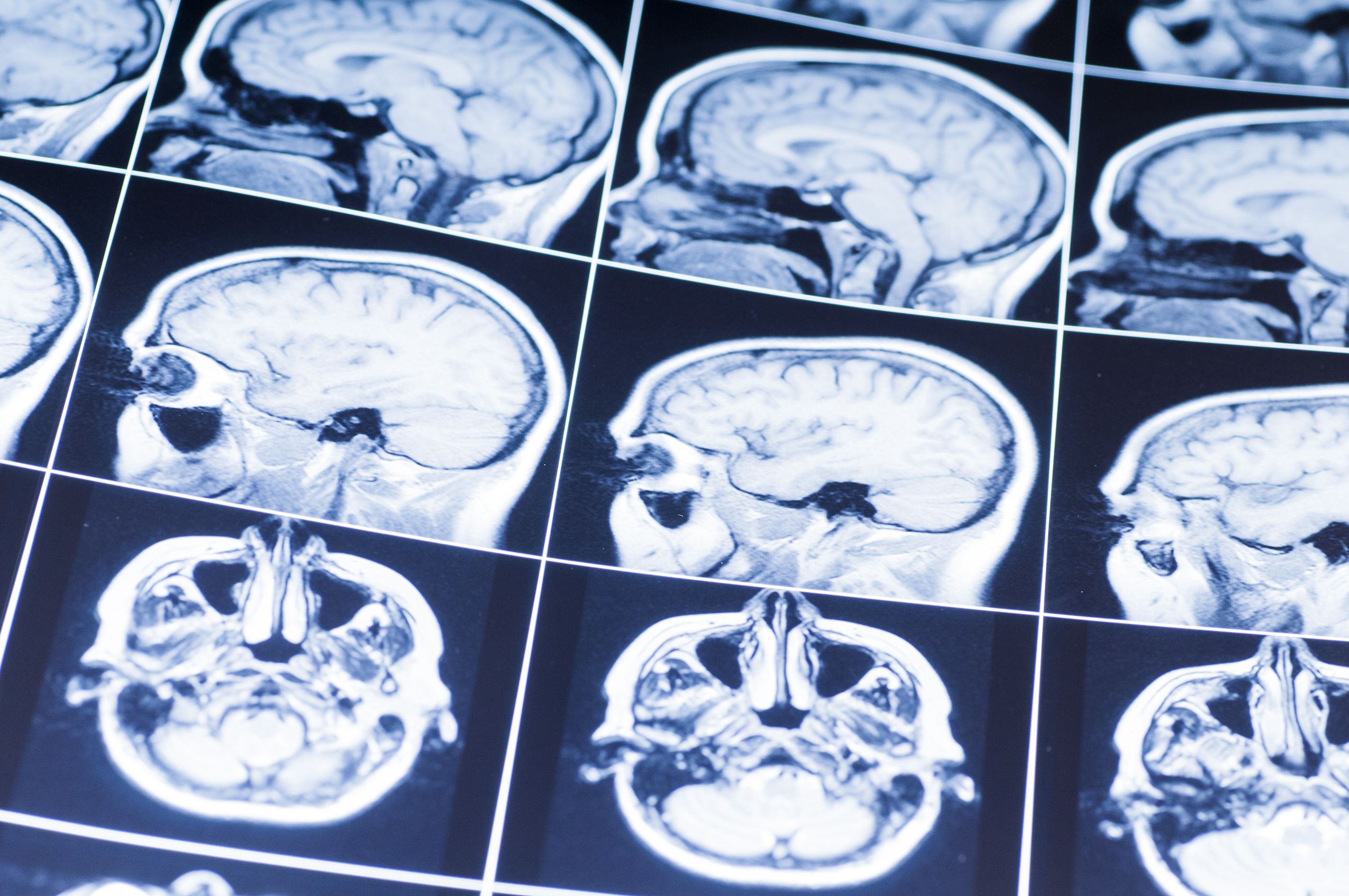 Brain MRI