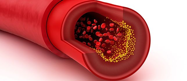 New Blood Vessel Model Leads to Progeria Insights