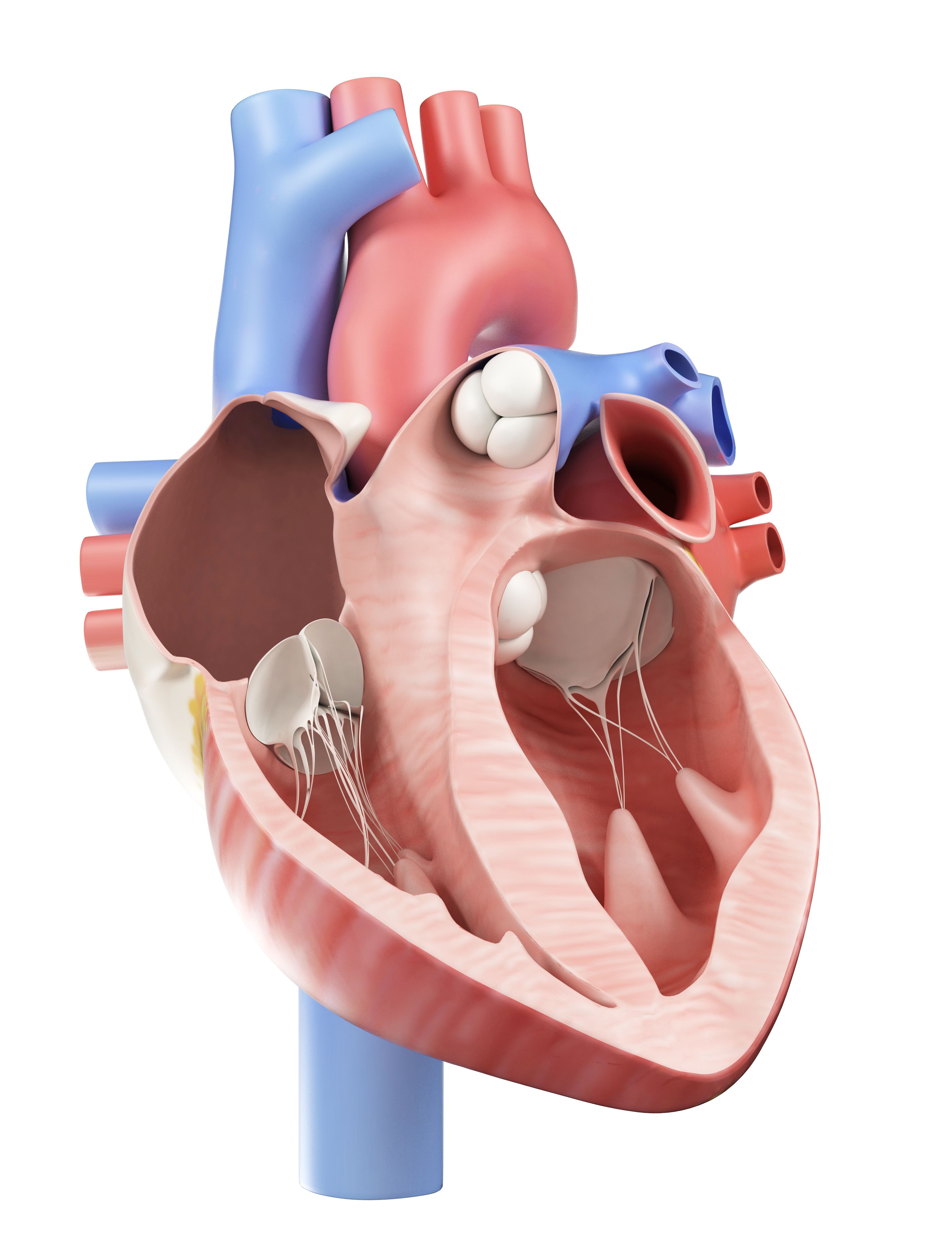 Psoriasis Linked With Severe Coronary Calcification, Heart Disease