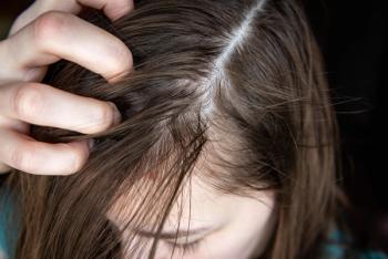 Women hair loss | Image Credit: Natallia - stock.adobe.com
