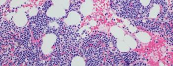 myeloma cells