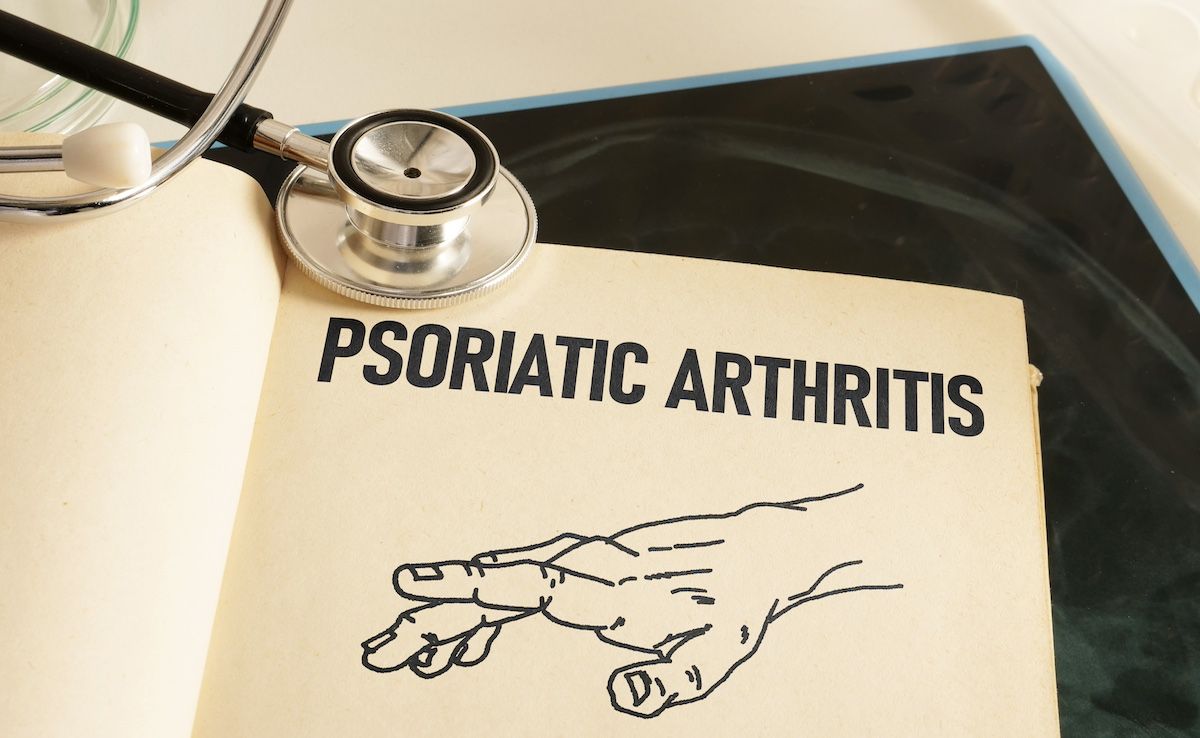 Psoriatic arthritis | Image Credit: © Andrii-stock.adobe.com