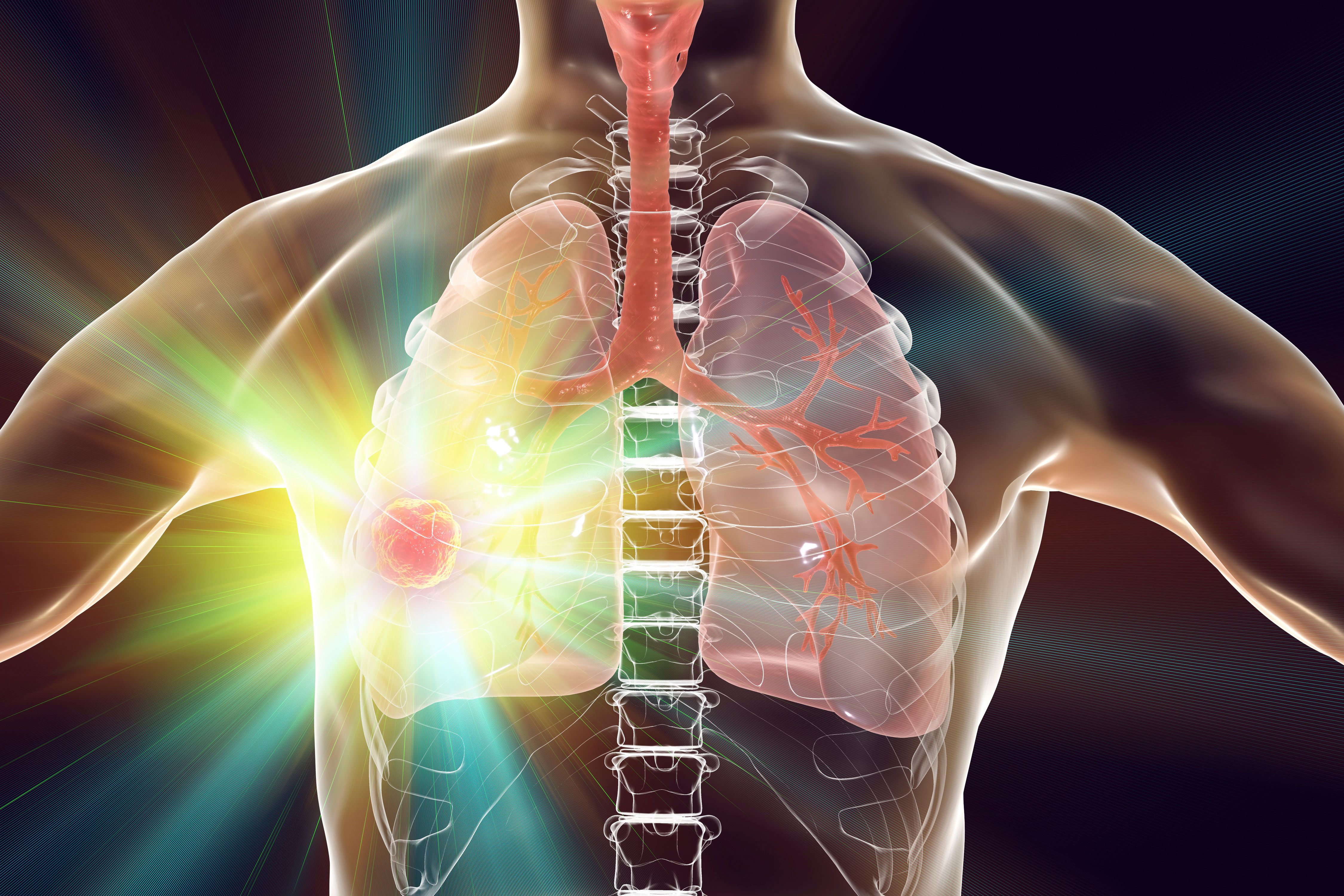 Lung cancer treatment and prevention concept | Image credit: Dr_Microbe - stock.adobe.com