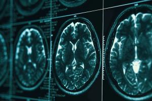 MRI head brain scan - DedMityay - stock.adobe.com