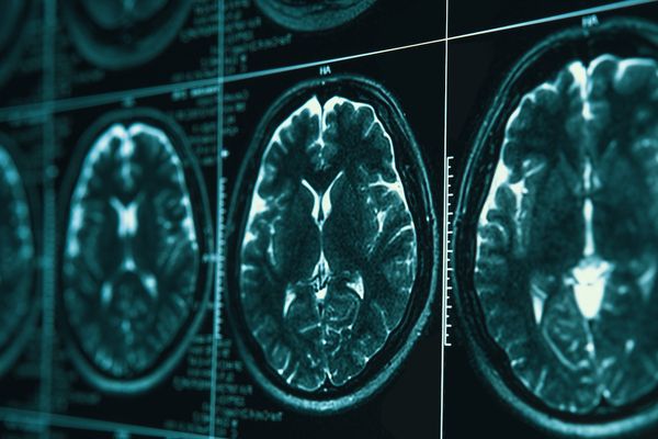 MRI head brain scan - DedMityay - stock.adobe.com