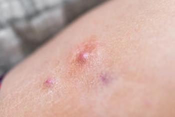 Hidradenitis suppurativa. | Image Credit: Kristina Blokhin -  stock.adobe.com 