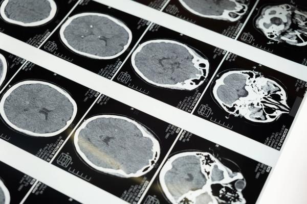 Detailed brain MRI | Image Credit: Cottonbro Studio - pexels.com