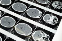 Detailed brain MRI | Image Credit: Cottonbro Studio - pexels.com