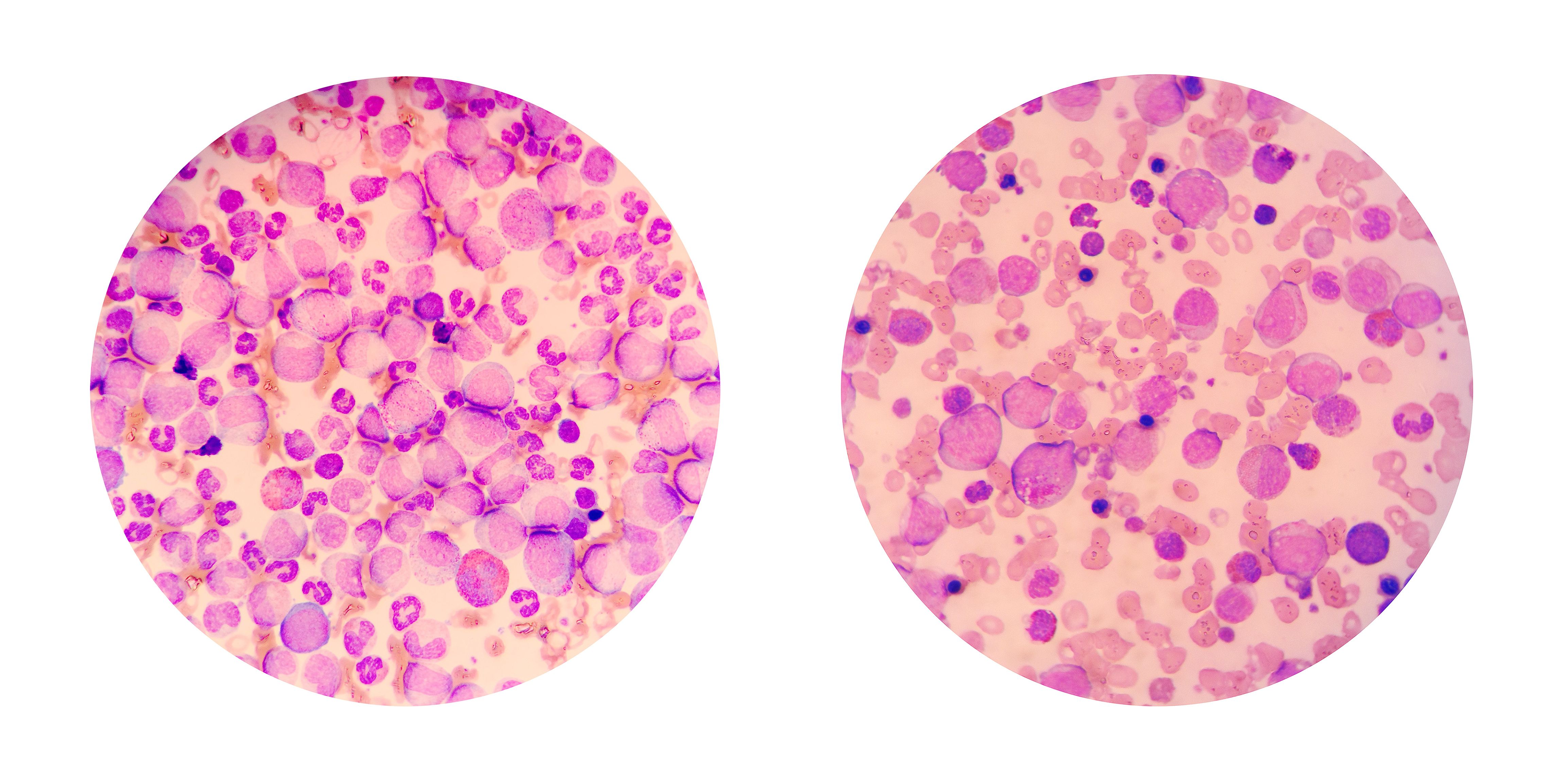 Blood smear AML | image credit: Chansom Pantip - stock.adobe.com