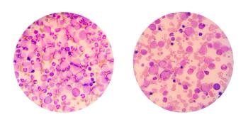 Blood smear AML | image credit: Chansom Pantip - stock.adobe.com