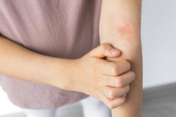 Pediatric Psoriasis | Image Credit:  Evgeniya Primavera - stock.adobe.com .jpeg