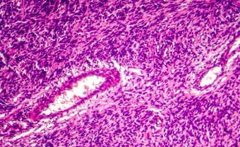 soft tissue sarcoma | Image Credit: Dr_Microbe-stock.adobe.com