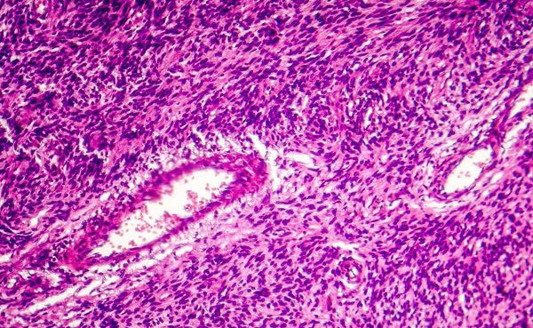 soft tissue sarcoma image | Image credit: Dr_Microbe - stock.adobe.com