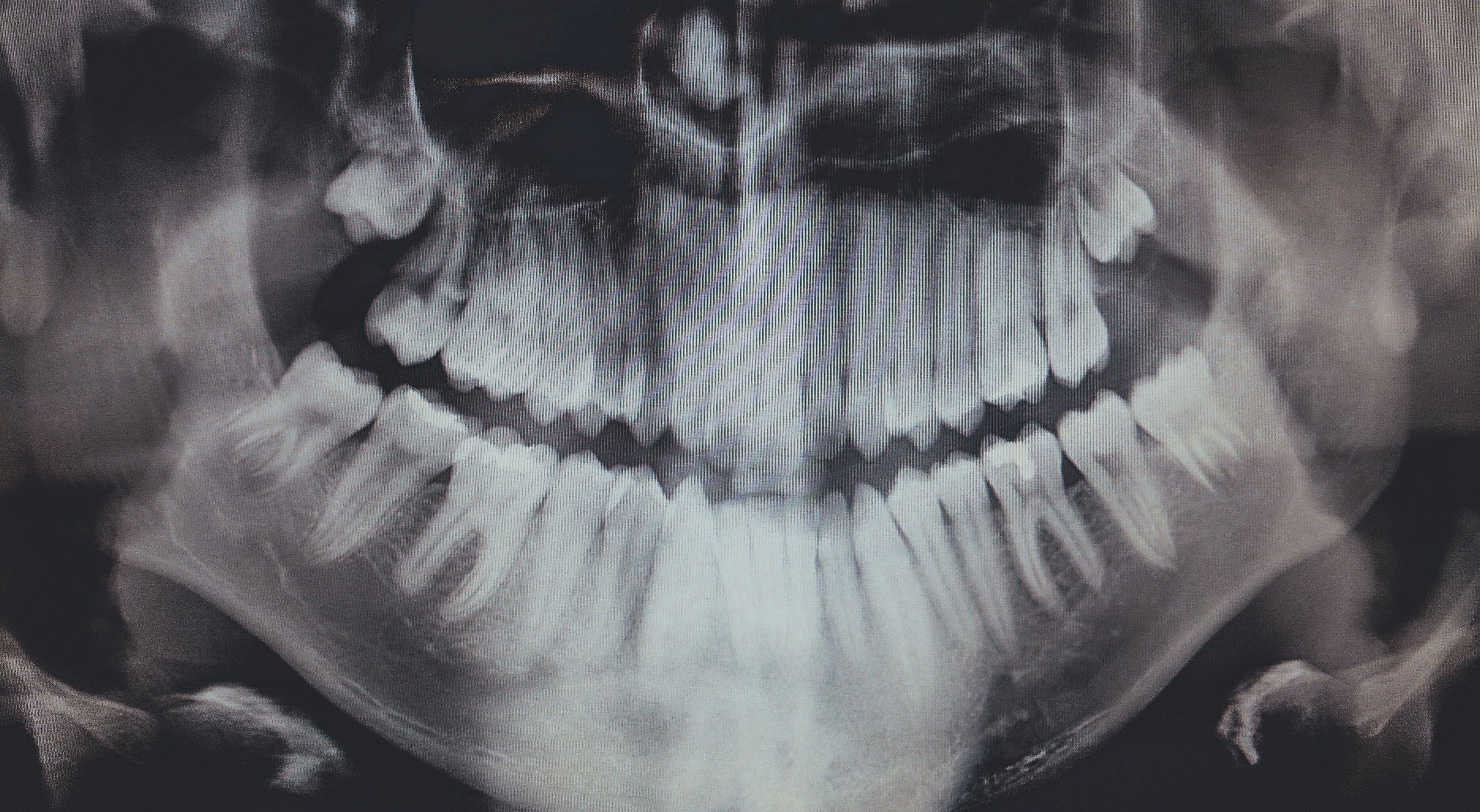 x-ray of teeth