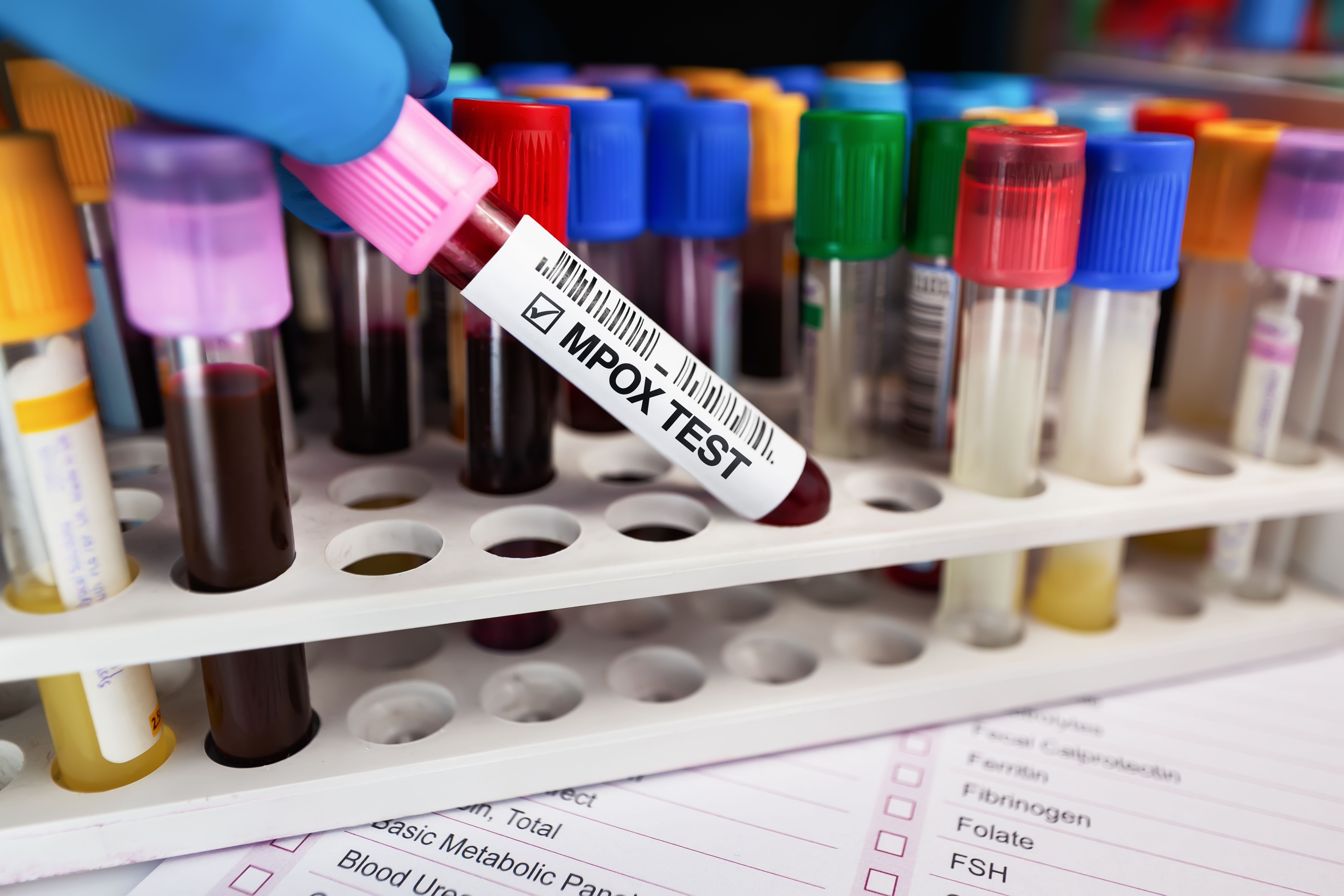 Technician with Blood collection tubes test for analysis of Smallpox and Monkeypox (MPXV). Doctor holding blood tube for MPOX Monkeypox disease test | Image Credit: angellodeco - stock.adobe.com