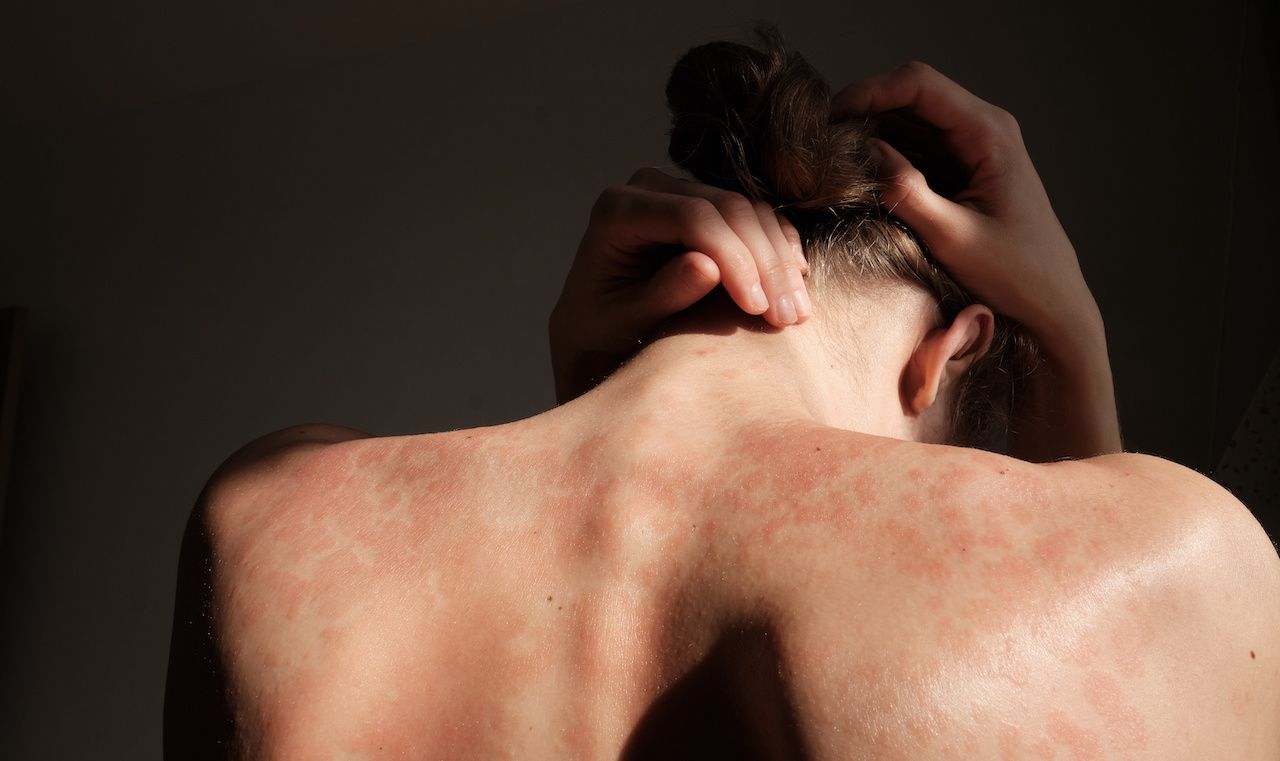 Close-up woman touches herself. Neck, back, spine. Psoriasis skin, eczema, rash and other skin diseases. A woman hides her face, she is ashamed of her autoimmune genetic disease. Imperfect beauty: © stockmaster - stock.adobe.com