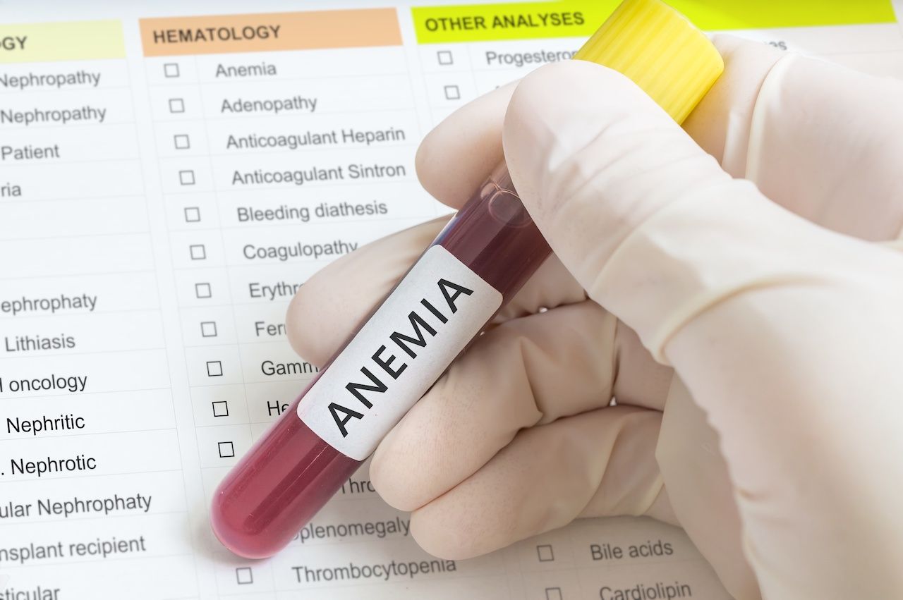 Image of a lab tech with a test tube labelled "anemia": vchalup - stock.adobe.com