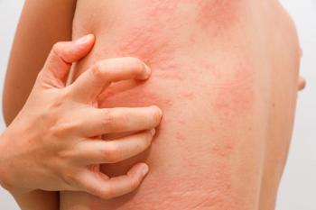 Allergic hives. | Image Credit: kanachaifoto - stock.adobe.com