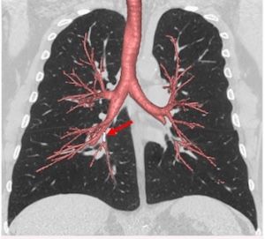 Concurrent Decline in FVC, Walking Test More Likely Associated With Disease Progression in IPF