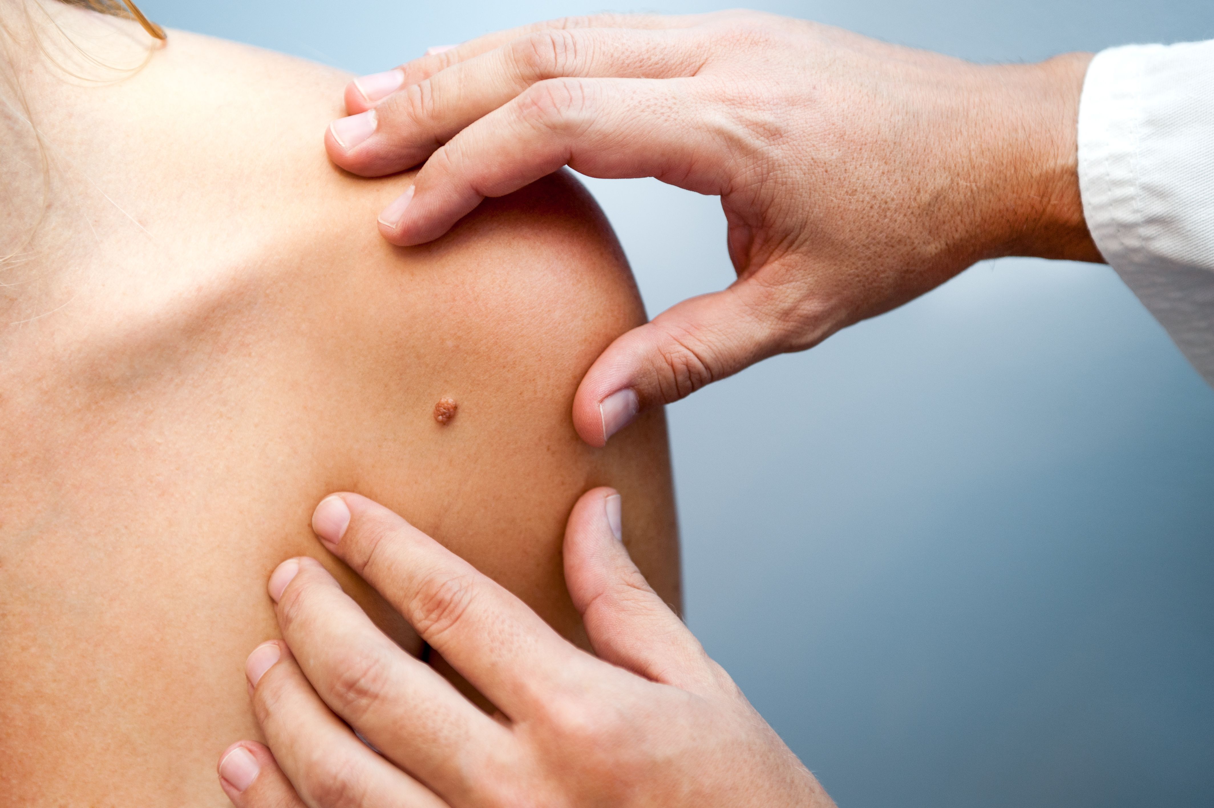 Skin cancer risk may be associated with immunosuppressant medication, although multiple studies exploring this relationship have not drawn concrete conclusions | image credit: Damian Gretka - stock.adobe.com