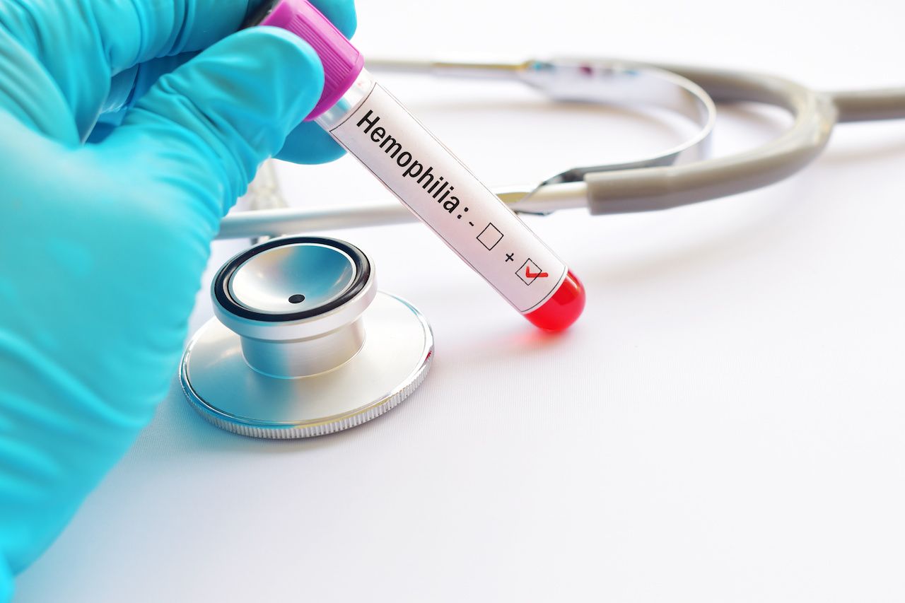 Blood sample positive with hemophilia disease: © jarun011 - stock.adobe.com