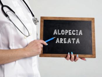 Alopecia Areata. | Image Credit: Yurii Kibalnik - stock.adobe.com