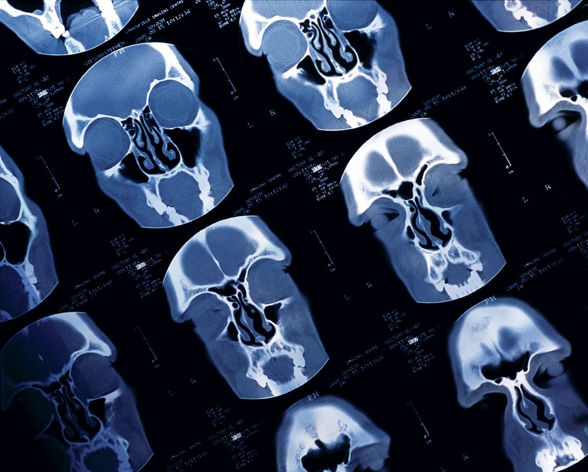 CT scans of sinus