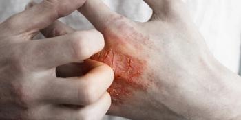 Psoriasis on hands
