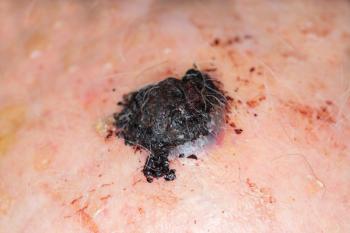 Melanoma | Image Credit: lavizzara - stock.adobe.com