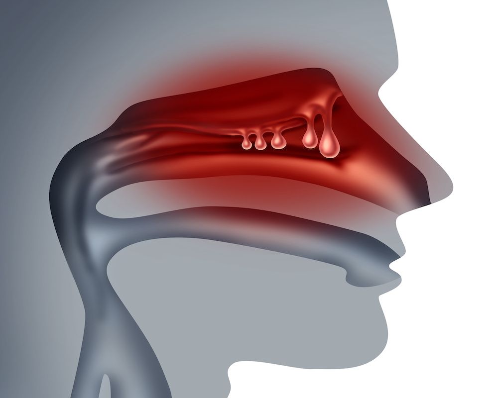 Nasal Polyps: © freshidea - stock.adobe.com