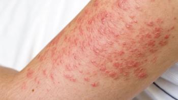 Chronic urticaria. | Image Credit: Cuoregentile - stock.adobe.com