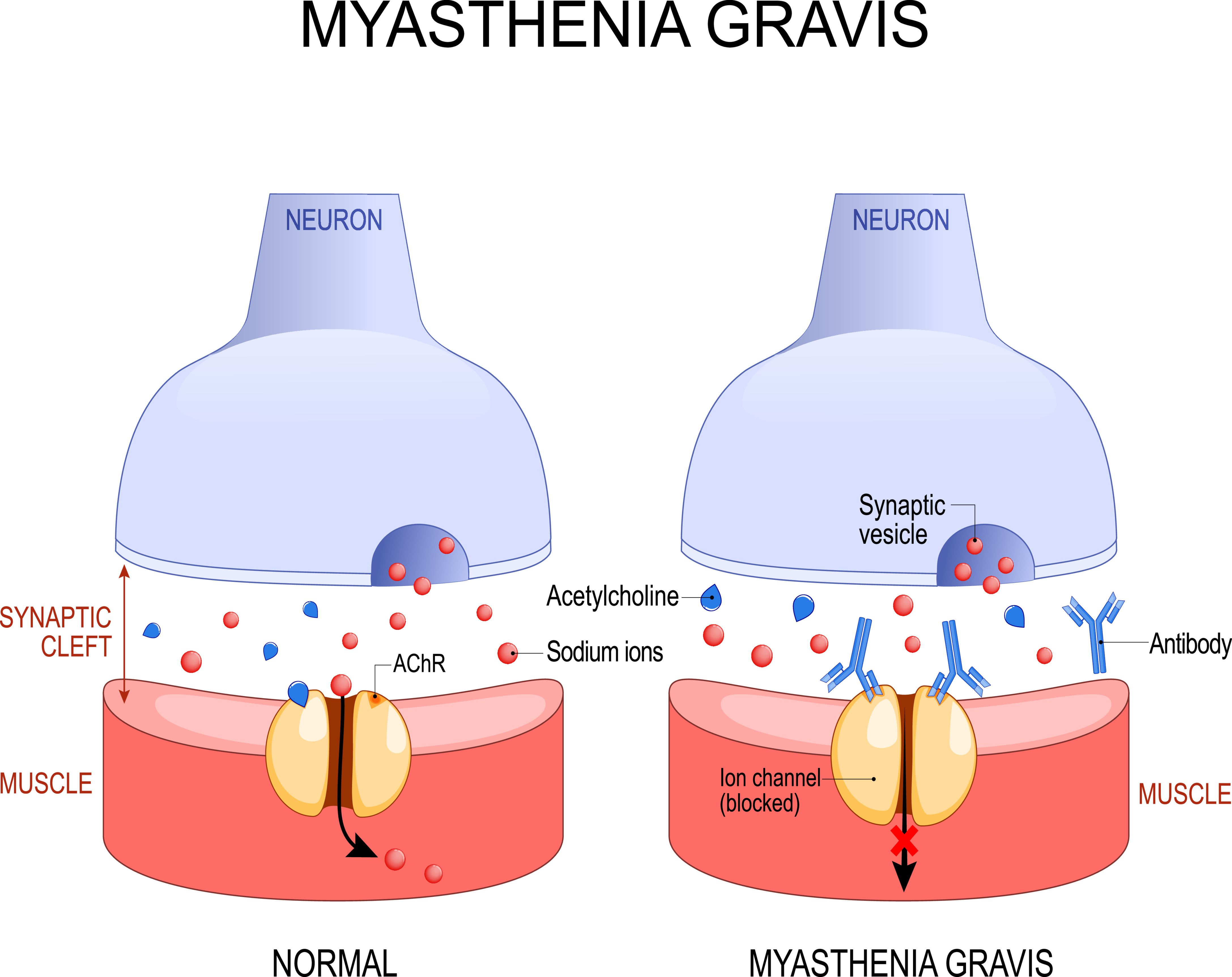 Myasthenia Gravis | Image Credit: © designua - stock.adobe.com