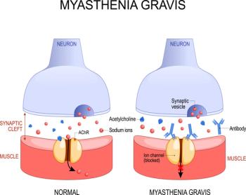 Myasthenia Gravis | Image Credit: © designua - stock.adobe.com