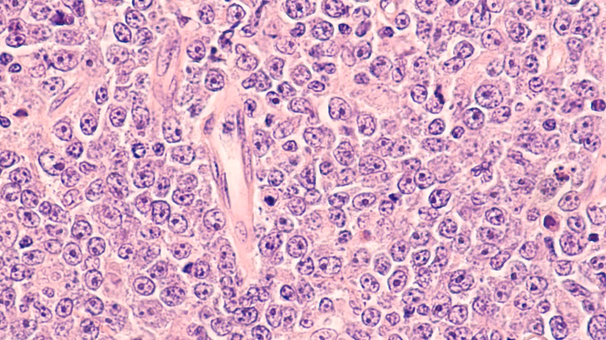 Diffuse large B-cell lymphoma | Image credit: David A Litman - stock.adobe.com