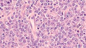 Diffuse large B-cell lymphoma | Image credit: David A Litman - stock.adobe.com