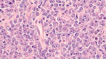 Diffuse large B-cell lymphoma | Image credit: David A Litman - stock.adobe.com