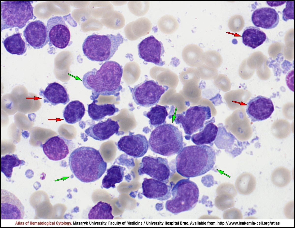 DLBCL | Image: Atlas of Haematological Cytology
