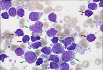 DLBCL | Image: Atlas of Haematological Cytology