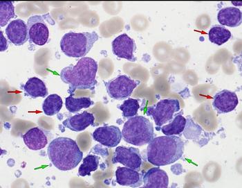 DLBCL | Image: Atlas of Haematological Cytology