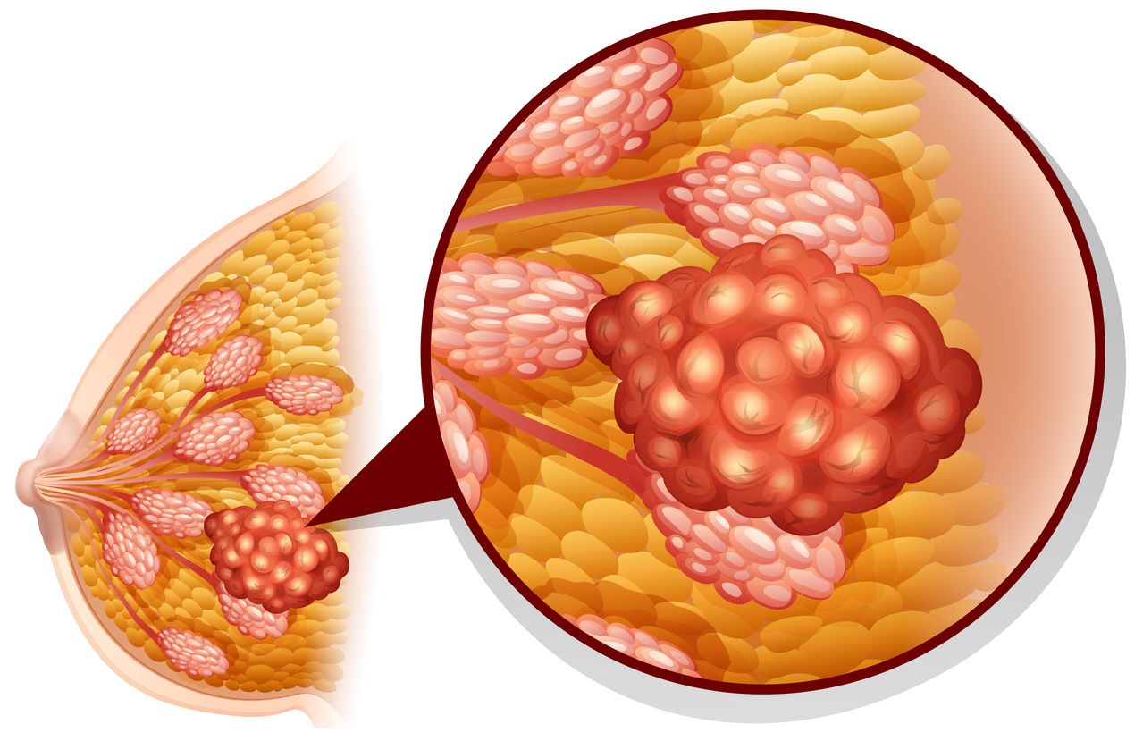 Anthracycline, Radiation Treatment for Childhood Cancer Shown to Increase Risk of Adult Breast Cancer