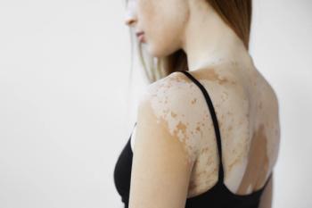 Vitiligo in light skin | Image credit: shurkin_son - stock.adobe.com